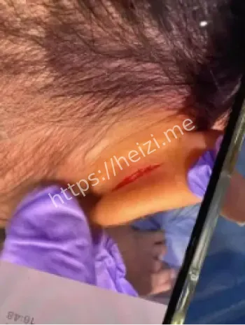 武汉托儿班女童耳朵撕裂